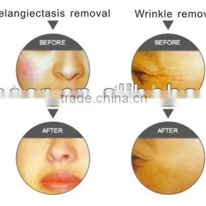 Beauty Equipment With IPL System to Remove Pore,acne, Wrinkles, Freckles thumbnail-2