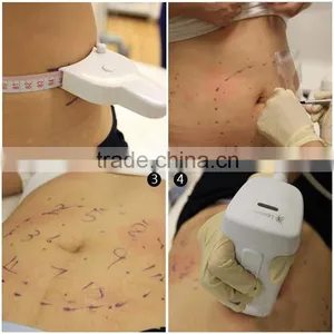 Home Use Fat Reduction Liposunic Machine thumbnail-6