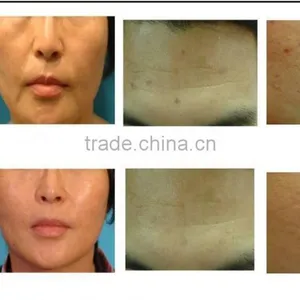 Professional 2 Handles / 5 Handles Micro Needle Fractional rf Wrinkle Removal Machine With Different Size Tips thumbnail-6