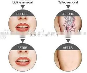 Zhengjia Medical Q Switched Nd Yag Laser For Tattoo 1-10Hz Removal/ Tattoo Removal Machine For Sale Varicose Veins Treatment thumbnail-3