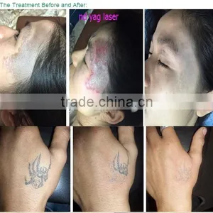 Newest nd Yag Laser Price Tattoo Removal Machine for Age Spot Removal thumbnail-5