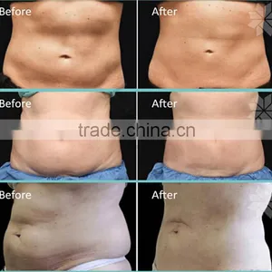 Non Surgical Ultrasound Fat Removal Top 1 Vertical Vacuum Cavitation System Non Surgical Ultrasonic Liposuction Type And Supersonic Operation System Slimming Machine thumbnail-6