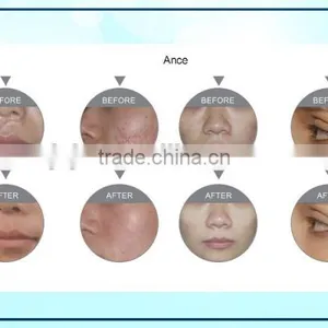 F5 Portable Style Fractional Home Laser Scar Removal Fractional Co2 Laser thumbnail-5