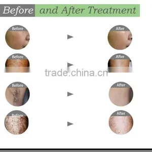 HOT Low Price Depitime Hair Removal/virgin Hair Removal/cheapest IPL Hair Removal thumbnail-5