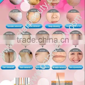 2016 New IPL Laser Hair Removal Machine thumbnail-2