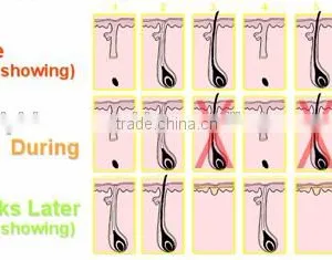 530-1200nm Economic Vertical Big Energy Elight Remove Tiny Wrinkle Ipl Machine&device For Hair Removal Vascular Lesions Removal thumbnail-2