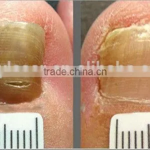 Ipl Laser Hair Removal Beauty Parlor Machine for Sale thumbnail-3