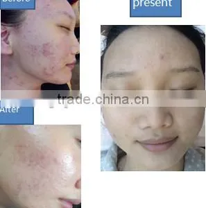Skin Analysis 2013 Oxygen Facial Machine Oxygen Jet Peel&No-needle Mesotherapy Machine For Sale-Oxy Skin Moisturizing thumbnail-3