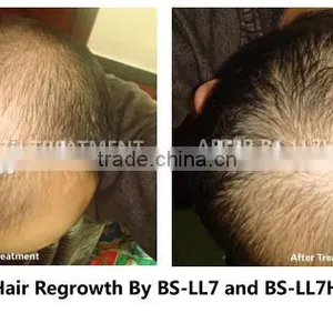 Laser Machine for Hair Restoration Laser Hair Regrowth Machine thumbnail-3