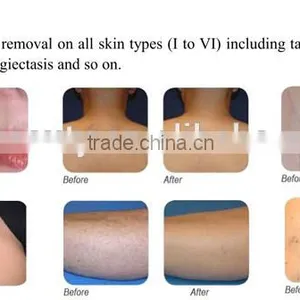 808nm Diode Depilation Laser Home Hair Removal Equipment Depilation Laser Home thumbnail-3