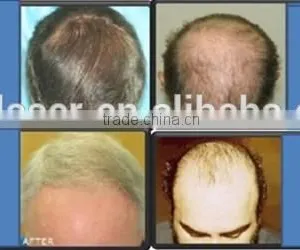 Led Light Therapy Home Devices PDT Laser Hair Growth Led Light Therapy For Skin /best Hair Loss Treatment Machine thumbnail-6