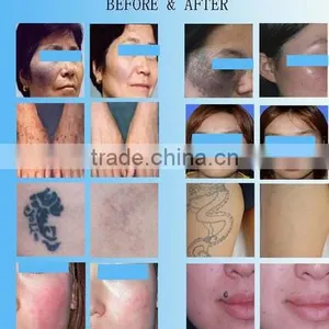 CE Approved New Handheld Tattoo Removal Laser Beauty Spa Machine for Sale q Switch nd Yag Pigment Freckle Removal thumbnail-5