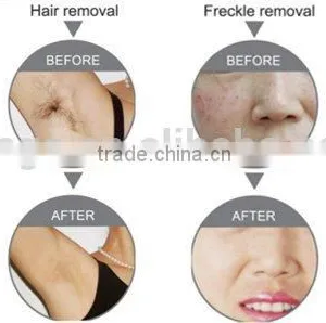 GIR-10 E-light (IPL+laser +RF) Multifunctional Beauty Care Machine for Sale Beauty Skin Care Machine thumbnail-3