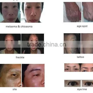 High Efficiency Laser Vascular Vein Removal Machine Skin Tag Removal Machine thumbnail-4