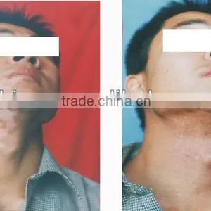 Epidermis Transplantation Vitiligo Machine thumbnail-2
