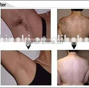 Hot Sale !!! Permanent Hair Removal Device/portable 808nm Diode Laser Device thumbnail-6