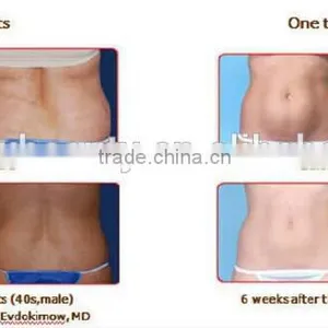 Portable Hot Selling Cryotherapy Fat Freezing for Cellulite Reducing Body Slimming Machine for Beauty Salon thumbnail-6