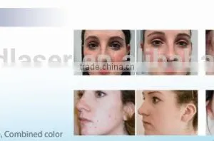 Freckle Removal      630nm Blue PDT Machine Spot Removal thumbnail-6