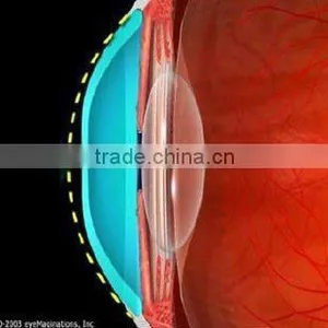 Digital Rigid Contact Lens for Corneal Reshape / MCT/ Luxuriant Metamorphosis of RGP Lenses thumbnail-1