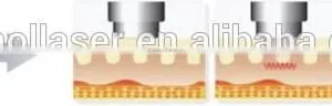 Best Microneedle Fractional RF Machine Stretch Marks thumbnail-3