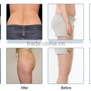 Top Sale Cryo Machine for Fat Freezing Permanent thumbnail-6