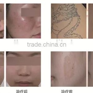 2016 Best Laser Skin Spot Remover Machine thumbnail-3