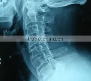 Medical X-ray Film Agfa Medical Dry Film for X-ray Machine Agfa Kodak Film thumbnail-2