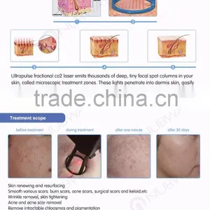 Stretch Mark Removal Medical CE Pigment Removal 30W Co2 Wrinkle Removal Fractional Machine With USA Coherent Laser thumbnail-3
