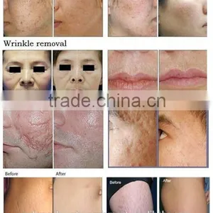 RF Pipe Fractional Co2 Carboxytherapy Laser Vaginal Tightening Machine Treat Telangiectasis thumbnail-5