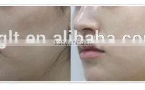 Mesogun Skin Whitening Remove Wrinkles vc Injection Machine Price thumbnail-5