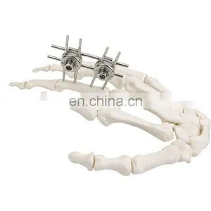 CE & ISO Marked Mini Fragment External Fixator Orthopedic Surgical Implant thumbnail-1
