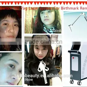 in Spanish Wholesale Tattoo Removal Yag Laser q Switched nd Yag Laser/tattoo Aesthetic Laser thumbnail-6