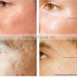 The Non-invasive Fractional rf Laser Beauty Machine for Wrinkle Removal and Face Lift thumbnail-6