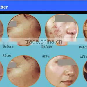 Pixel Co2 Fractional Laser thumbnail-6