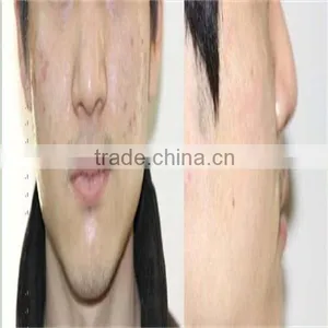 Fast Skin Rejuvenation and Tightening Beauty Machine Portable Intracel Fractional rf Microneedle thumbnail-6