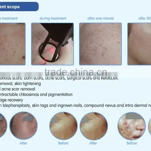 Most Advanced High Quality Beauty Equipment 10600 nm Laser Co2 Surgical Laser With USA Tube thumbnail-5