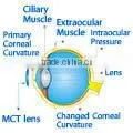 Hard Lens For Low Myopia/MCT Lenses/MCT Technology thumbnail-1