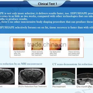 Back Tightening 2016 Hot Sales ! Nubway Beauty Machine Hifu Fda Slimming Hifu Machine Korea Hifushape Machine Hifu Korea With CE Deep Wrinkle Removal thumbnail-5