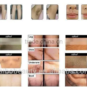 2016 Trending Products 808nm Diode Laser Hair Removal Beauty Cosmetics Kemei Hair Remover thumbnail-6