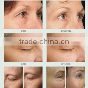 AYJ-C19(CE) Dot Matrix Portable rf Thermagic Galvanic Facial Machine thumbnail-6