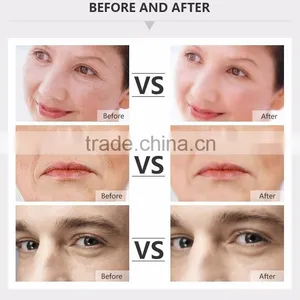 Personalcare Skin Lightening Radio Frequency Machine thumbnail-4