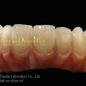 Dental Implant Prosthesis, Implant Denture, Dental Prosthesis, Laboratoire Dentaire, Dentallabor, Laboratorio Dental, Dental Laboratory, Shenzhen LJ Dental Lab China thumbnail-5