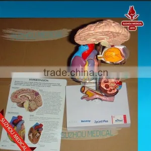 Effects of Hypertension, 5 Parts thumbnail-3