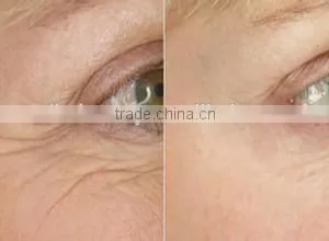 Portable Radio Frequency Fractional Magic Pot rf and Microneedle rf Wrinkle Removal Machine/ /home us thumbnail-5