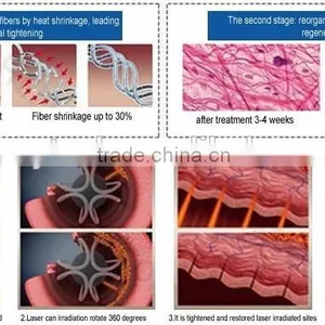 Professional Fractional Co2 Laser Vagina Co2 Fractional Laser VH613 thumbnail-5