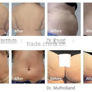 Vacuum Body Massager Anti Cellulite Suction Machine Radiofrequency Machine thumbnail-4
