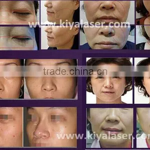 Most Popular Hifu Treatment thumbnail-4