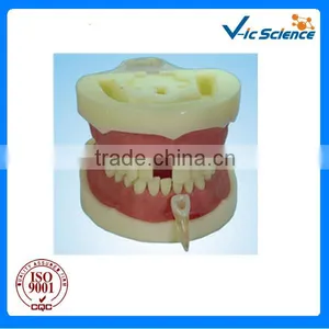 Root Canal Filling Model Dental Model thumbnail-1