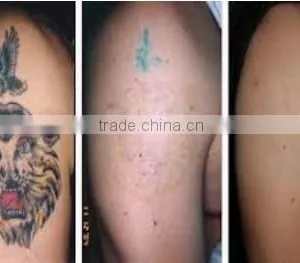 ND Yag Laser Tattoo Removal Machine With Laser Removal Tattoo Machine Q-switch Fuction/Q-switch ND Yag Naevus Of Ota Removal thumbnail-6