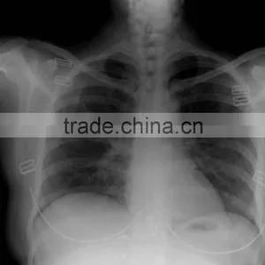 Ccd Flat Panel X-ray Detector 14x17 thumbnail-3